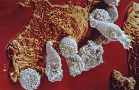 Т киллеры атакуют атипичную клетку